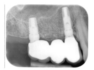 96609177 Sistemi ai Fosfori Hy Scan Fosfori My Ray lastre a fosfori size 2
