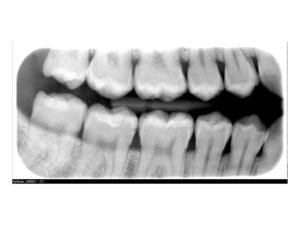 Sistemi ai Fosfori Hy Scan Fosfori My Ray