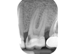 96609175 Sistemi ai Fosfori Hy Scan Fosfori My Ray lastre a fosfori-size 0